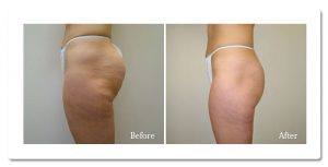 VelaShape Before and After