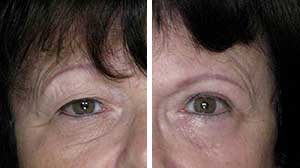 Blepharoplasty Before/After