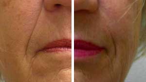 Dermal Fillers Before/After Gallery Dermal Fillers Before/After Gallery