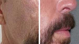 Laser Resurfacing Before/After Gallery
