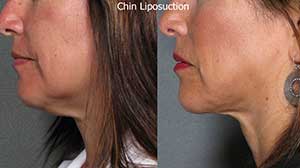 Liposuction Before/After Gallery