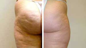 Velashape Before/After Gallery Velashape Before/After Gallery