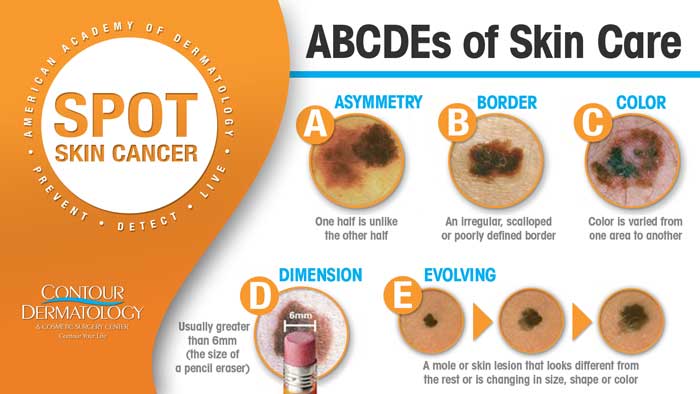 Five Warning Signs Of Skin Cancer Contour Dermatology