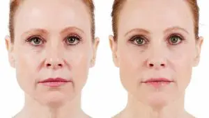 Voluma Before and After