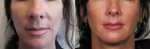 Facial Filler Before and After