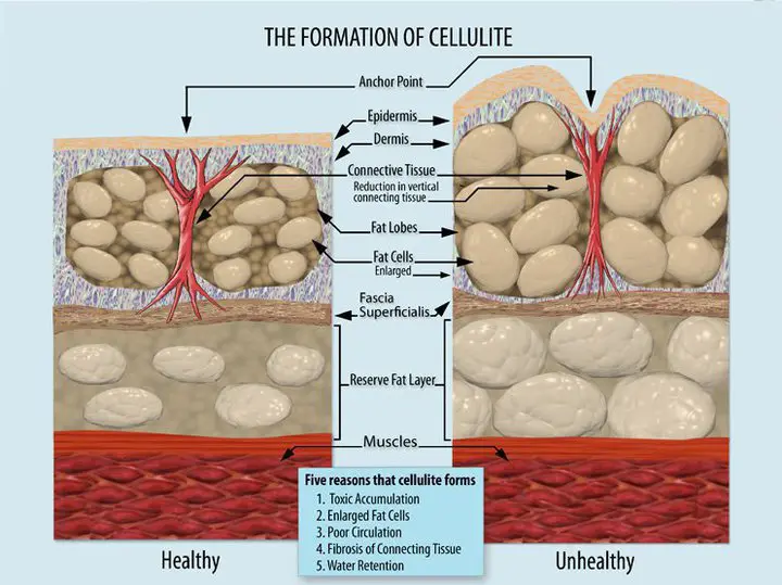 Cellulite, Causes & Treatment