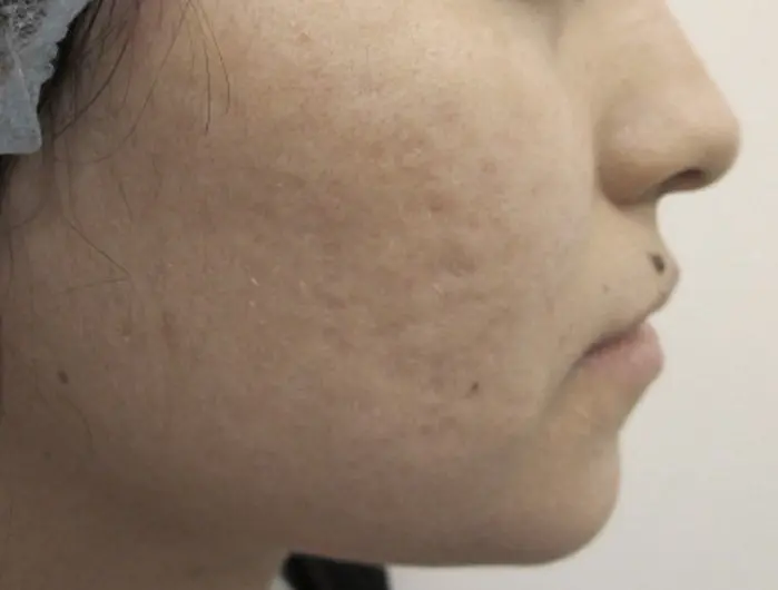 Woman Acne Scars After Smoothbeam Laser
