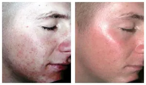 Acne Before & After