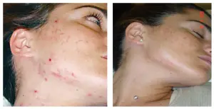 Acne Treatment Before & After
