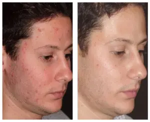 Acne Before & After