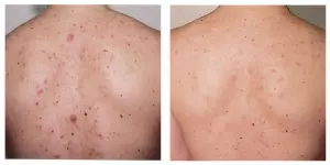 Acne Before & After