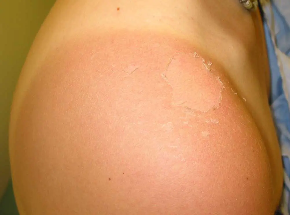 Photo of a Sunburn on shoulder