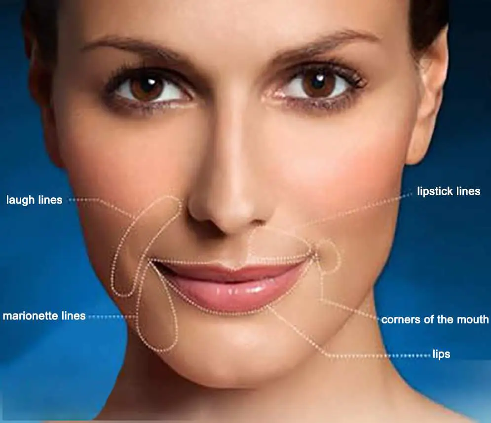 Restylane Facial Filler, Made in Sweeden! | Contour Dermatology Restylane Facial Filler, Made in Sweeden!