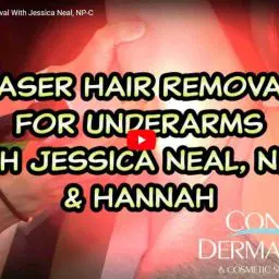 Laser Hair Removal for Underarms