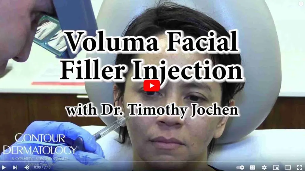 Voluma Facial Filler Injection