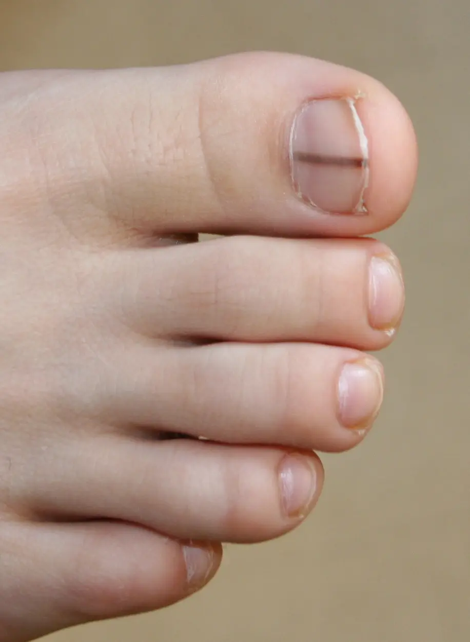 Toenail F?ngus Treatment,32pcs Nail Repair Patches,nail Repair Treatment  For Restores Damaged Nails And Appearance Of Discolored | Fruugo BH