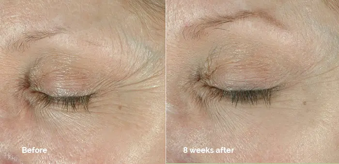 Obagi Elastiderm Eye Cream Before and After