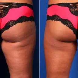 CoolSculpting Inner-Thighs