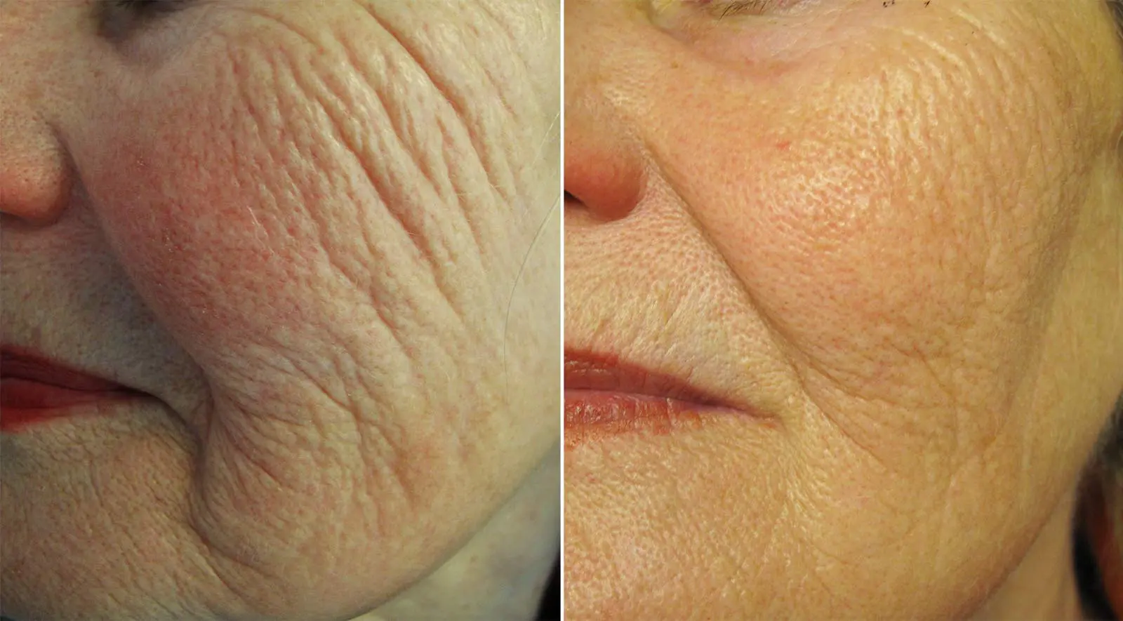 Patient 149342194  Profound RF Skin Tightening Before & After