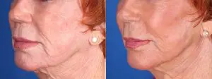 3 ml Restylane, 4 ml Voluma