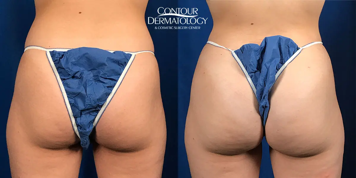 Butt Lift Before and After: Fat Transfers Amazing Results!