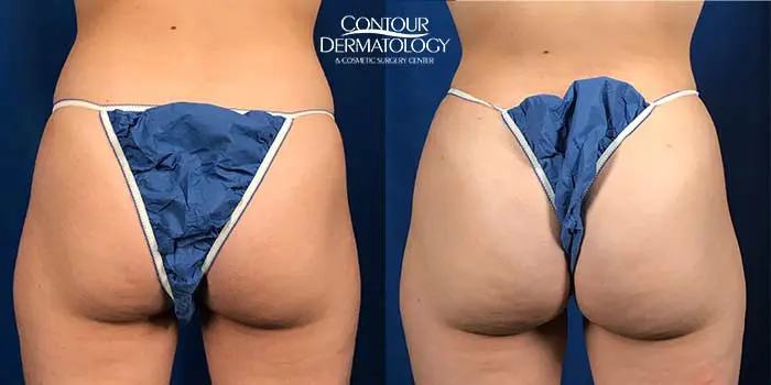Brazilian Butt Lift – Fat Transfer to the Buttocks – Back View