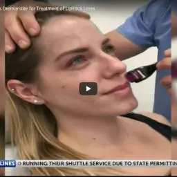 Dr. Timothy Jochen of Contour Dermatology & Cosmetic Surgery Center discusses how the dermaroller can improve the appearance of lipstick lines that appear around the mouth as we age.