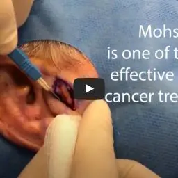 Mohs Micrographic Surgery is specialized, highly effective skin cancer treatment that will completely remove the skin cancer.