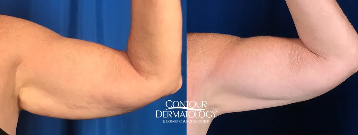 Coolsculpting for the Arms  Contouring for Flabby Arms