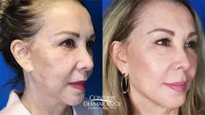 Liquid Facelift with Juvéderm Voluma