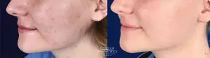 Accutane and SmoothBeam Laser