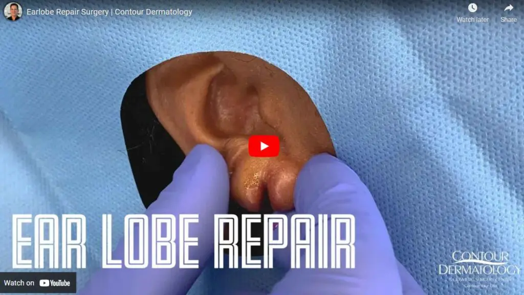 Dr. Jochen goes into action as he performs an earlobe repair surgery. There are plenty of reasons why patients come in for this procedure like stretched earlobes because of heavy earrings.