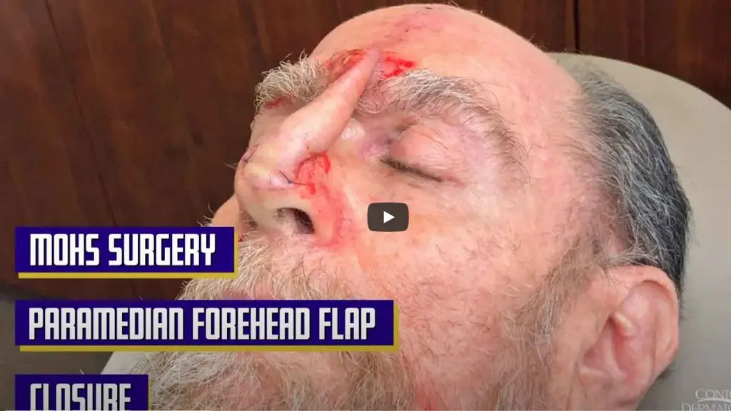 Dr. Jochen performs a Paramedian Forehead Flap, also called interpolated flap, to close a defect on the tip of the nose after a Mohs Surgery, Part 2.