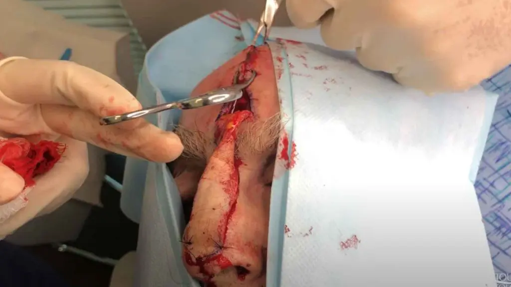 Dr. Jochen performs a Paramedian Forehead Flap, also called interpolated flap, to close a defect on the tip of the nose after a Mohs Surgery.