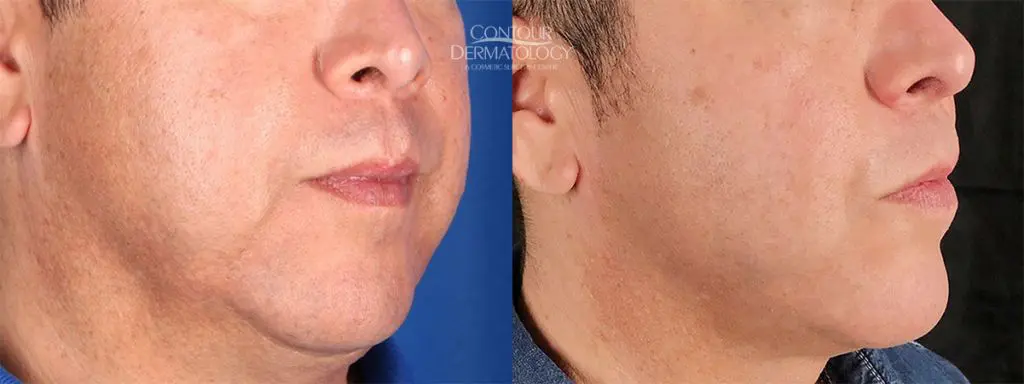 Kybella for jowls, 3 months after. 51 yr old man. | Contour Dermatology Kybella for jowls, 3 months after. 51 yr old man.