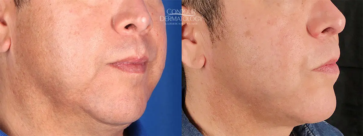 Kybella for jowls, 3 months after. 51 yr old man.