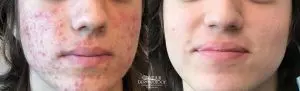 Accutane, Before & After