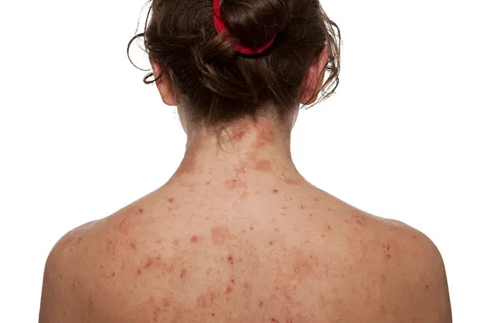 girl-with-eczema-on-back