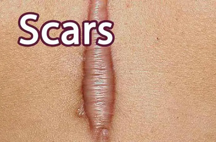 Scars and scar types