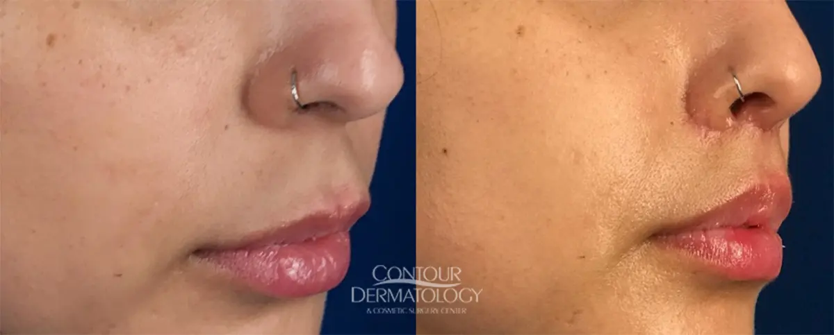 Lip Lift Before and After