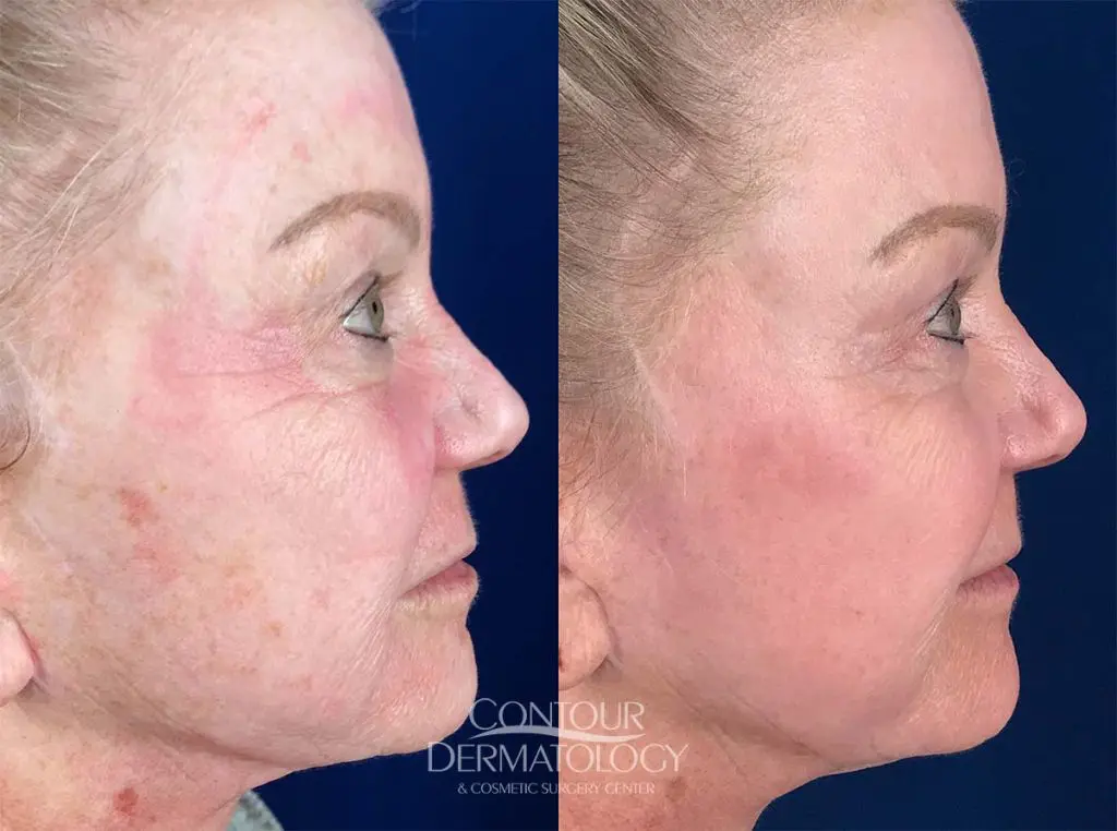 Fractional Co2 Full Face