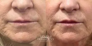 RHA Filler, Lips