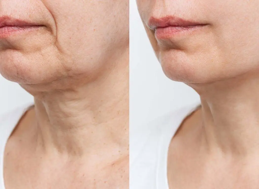 Rejuvenation efforts tend to focus on the face but the neck is equally deserving of attention. The area is just as prone to wrinkling and sagging.