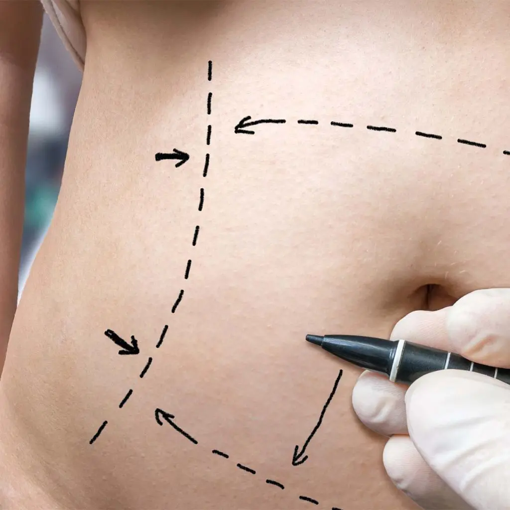 Abdominoplasty – also known as a tummy tuck – is a common procedure designed to correct changes following pregnancy or significant weight loss.