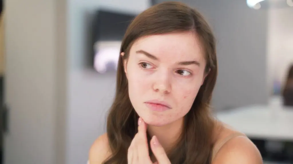 girl-with-acne | Contour Dermatology girl with acne