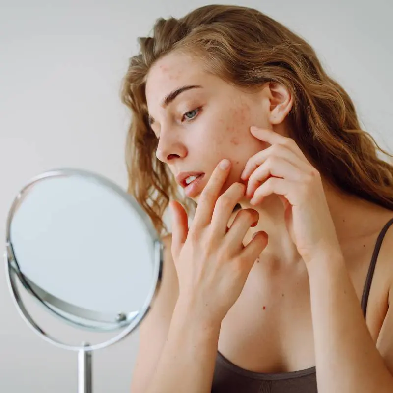 girl-with-acne-main | Contour Dermatology