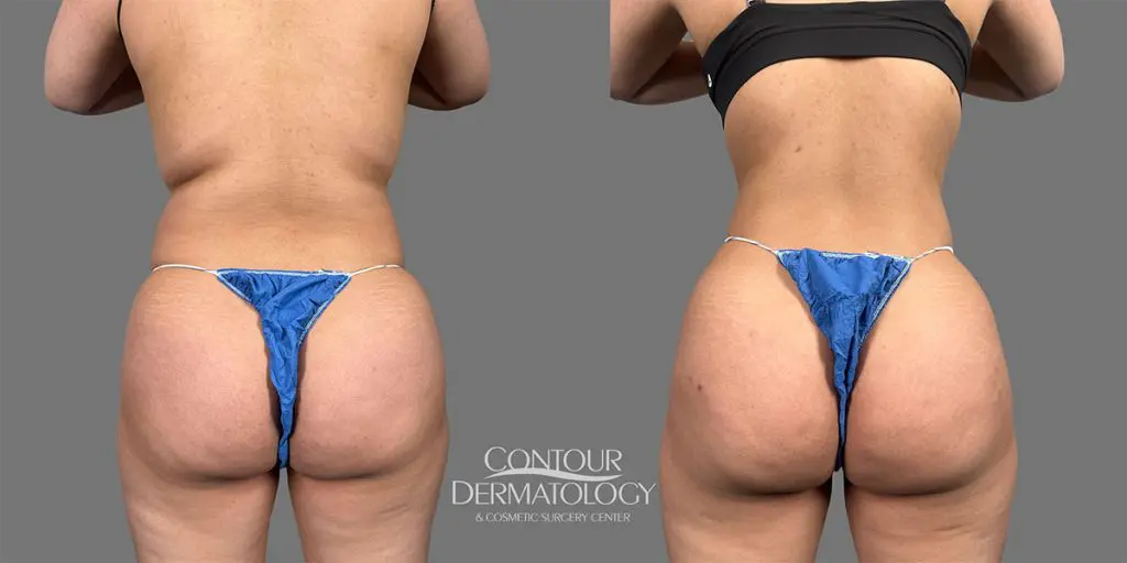 Lipo to Flanks, Abdomen, and Fat Transfer to Buttocks