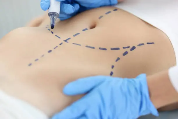tummy-tuck