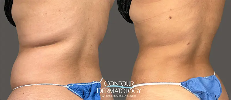 3 months after Liposculpture for Flanks Area