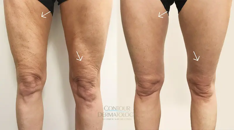 After 5 VelaShape III Treatments for Skin Laxity on Thighs/Knees | Contour Dermatology After 5 VelaShape III Treatments for Skin Laxity on Thighs/Knees